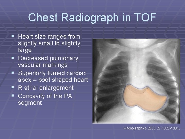 Chest Radiograph in TOF § Heart size ranges from § § slightly small to