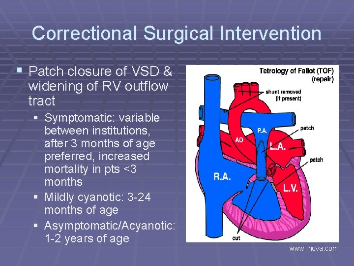 Correctional Surgical Intervention § Patch closure of VSD & widening of RV outflow tract
