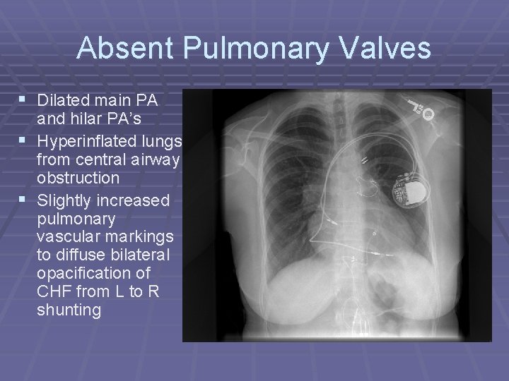 Absent Pulmonary Valves § Dilated main PA and hilar PA’s § Hyperinflated lungs from