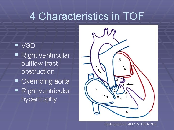 4 Characteristics in TOF § VSD § Right ventricular outflow tract obstruction § Overriding