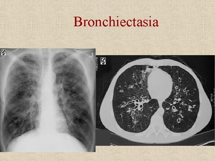 Bronchiectasia 