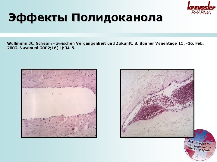Эффекты Полидоканола Wollmann JC. Schaum - zwischen Vergangenheit und Zukunft. 8. Bonner Venentage 15.