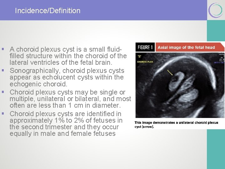 Incidence/Definition § A choroid plexus cyst is a small fluidfilled structure within the choroid