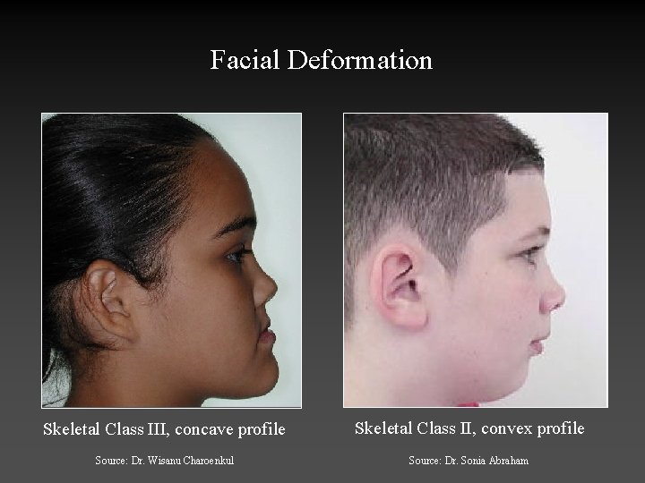 Facial Deformation Skeletal Class III, concave profile Skeletal Class II, convex profile Source: Dr.