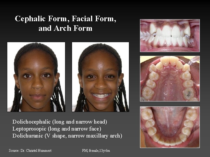 Cephalic Form, Facial Form, and Arch Form Dolichocephalic (long and narrow head) Leptoprosopic (long