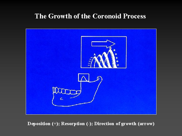 The Growth of the Coronoid Process Deposition (+); Resorption (-); Direction of growth (arrow)