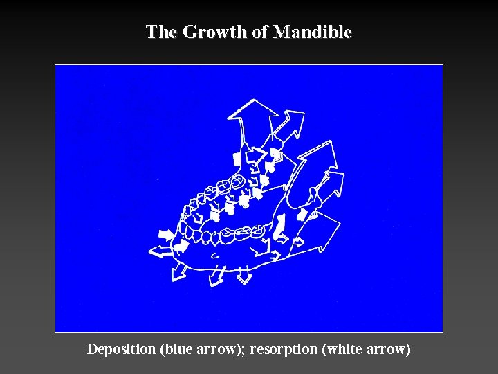 The Growth of Mandible Deposition (blue arrow); resorption (white arrow) 