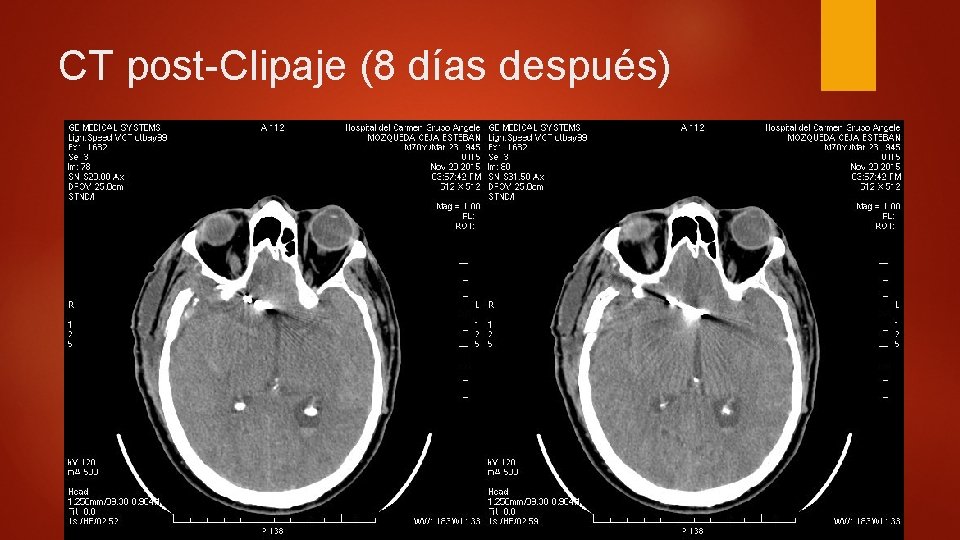 CT post-Clipaje (8 días después) 