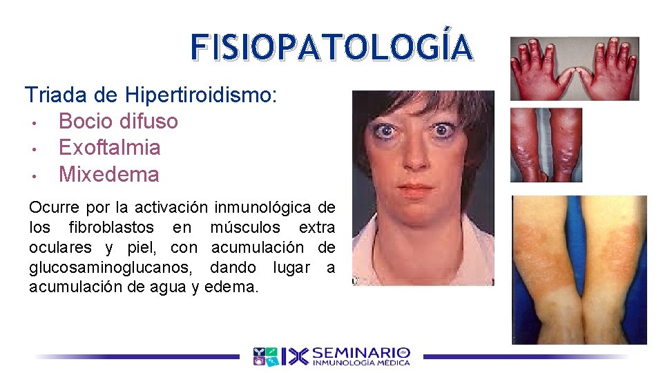 FISIOPATOLOGÍA Triada de Hipertiroidismo: • Bocio difuso • Exoftalmia • Mixedema Ocurre por la