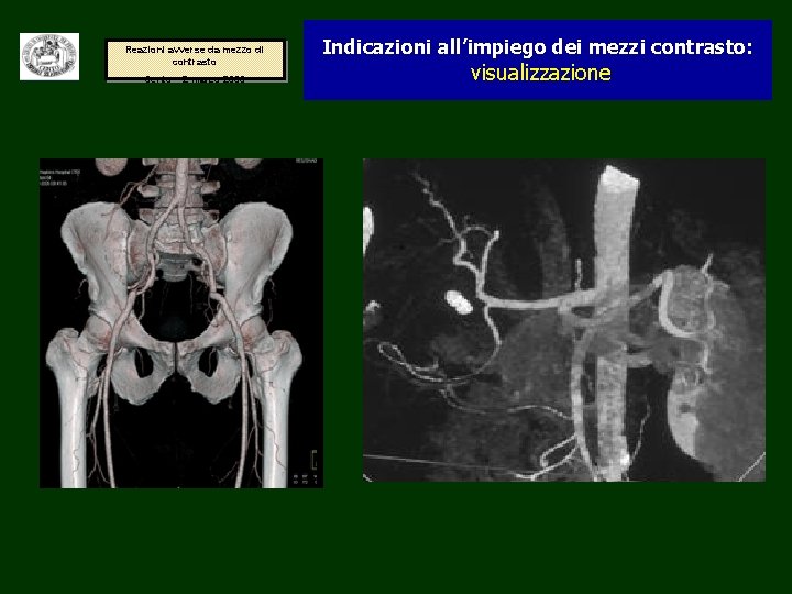 Reazioni avverse da mezzo di contrasto Cento – 2 marzo 2006 Indicazioni all’impiego dei