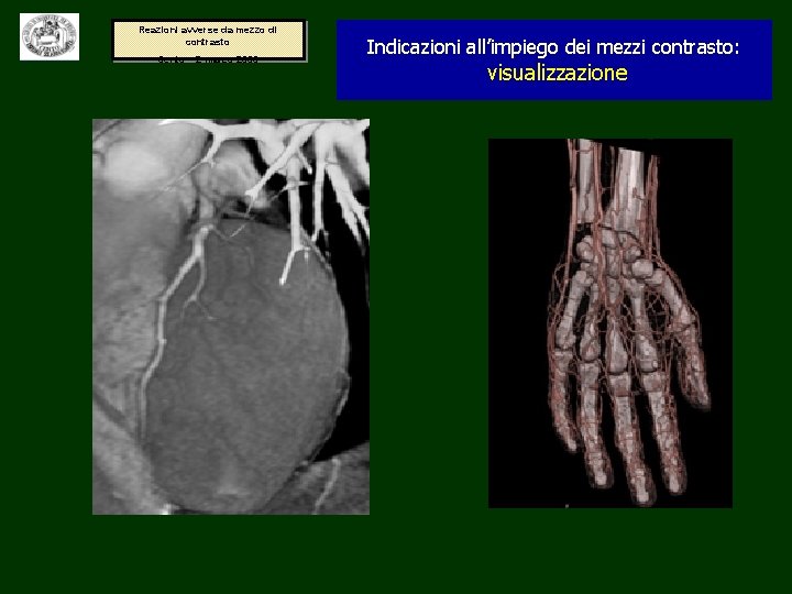 Reazioni avverse da mezzo di contrasto Cento – 2 marzo 2006 Indicazioni all’impiego dei