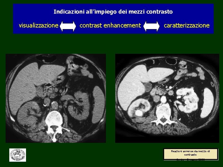 Indicazioni all’impiego dei mezzi contrasto visualizzazione contrast enhancement caratterizzazione Reazioni avverse da mezzo di