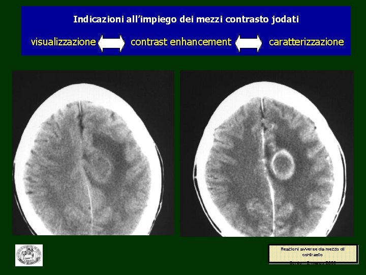 Indicazioni all’impiego dei mezzi contrasto jodati visualizzazione contrast enhancement caratterizzazione Reazioni avverse da mezzo