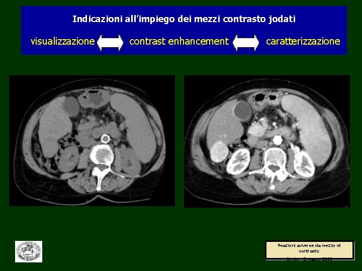 Indicazioni all’impiego dei mezzi contrasto jodati visualizzazione contrast enhancement caratterizzazione Reazioni avverse da mezzo