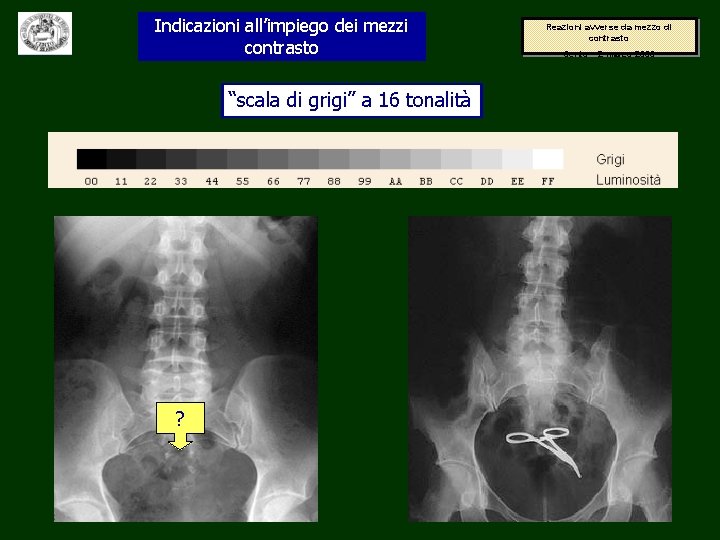 Indicazioni all’impiego dei mezzi contrasto “scala di grigi” a 16 tonalità ? Reazioni avverse