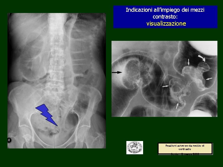 Indicazioni all’impiego dei mezzi contrasto: visualizzazione Reazioni avverse da mezzo di contrasto Cento –