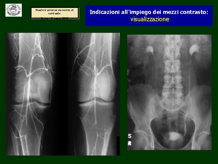 Reazioni avverse da mezzo di contrasto Cento – 2 marzo 2006 Indicazioni all’impiego dei