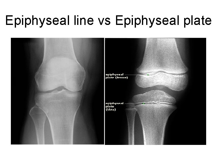 Epiphyseal line vs Epiphyseal plate 