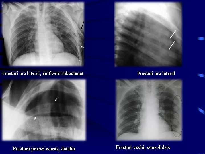 Fracturi arc lateral, emfizem subcutanat Fractura primei coaste, detaliu Fracturi arc lateral Fracturi vechi,