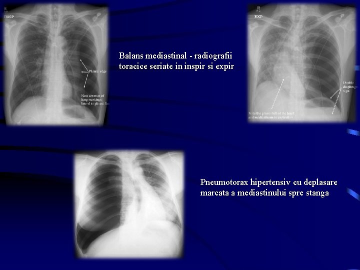 Balans mediastinal - radiografii toracice seriate in inspir si expir Pneumotorax hipertensiv cu deplasare