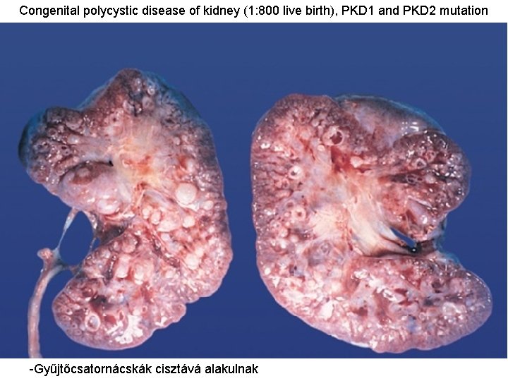 Congenital polycystic disease of kidney (1: 800 live birth), PKD 1 and PKD 2