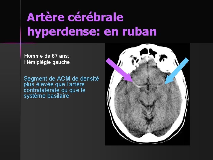 Artère cérébrale hyperdense: en ruban Homme de 67 ans: Hémiplégie gauche Segment de ACM