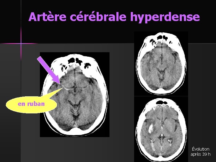 Artère cérébrale hyperdense en ruban Évolution après 39 h 