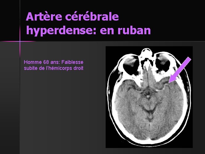 Artère cérébrale hyperdense: en ruban Homme 68 ans: Faiblesse subite de l’hémicorps droit 