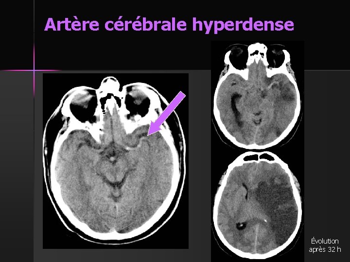 Artère cérébrale hyperdense Évolution après 32 h 