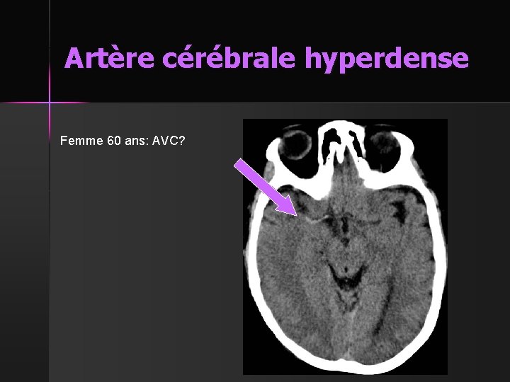 Artère cérébrale hyperdense Femme 60 ans: AVC? 