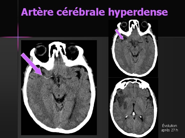 Artère cérébrale hyperdense Évolution après 27 h 