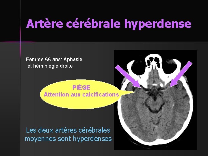 Artère cérébrale hyperdense Femme 66 ans: Aphasie et hémiplégie droite PIÈGE Attention aux calcifications