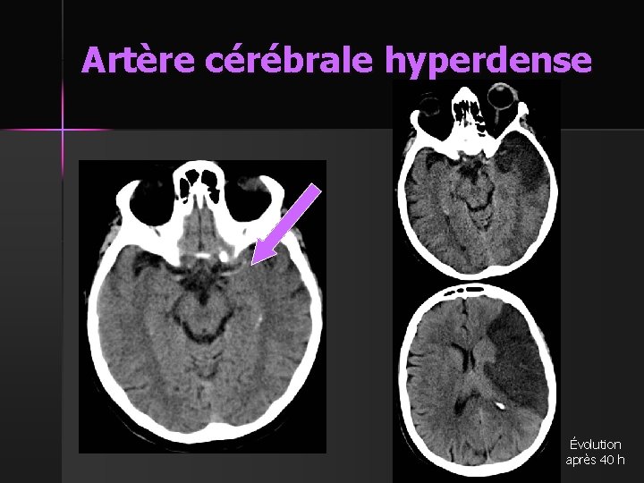 Artère cérébrale hyperdense Évolution après 40 h 