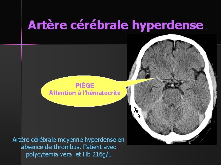 Artère cérébrale hyperdense PIÈGE Attention à l'hématocrite Artère cérébrale moyenne hyperdense en absence de