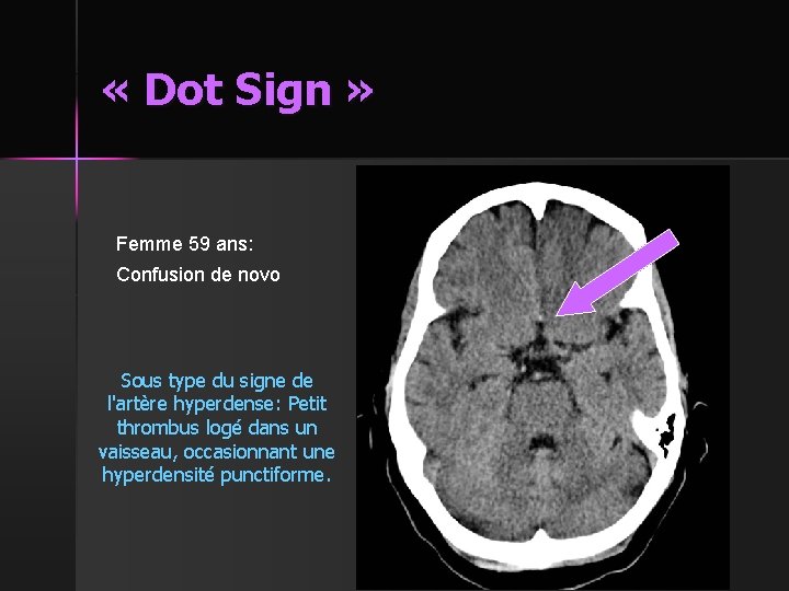  « Dot Sign » Femme 59 ans: Confusion de novo Sous type du