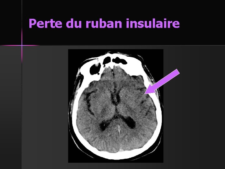 Perte du ruban insulaire 