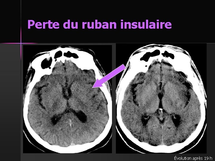 Perte du ruban insulaire Évolution après 19 h 