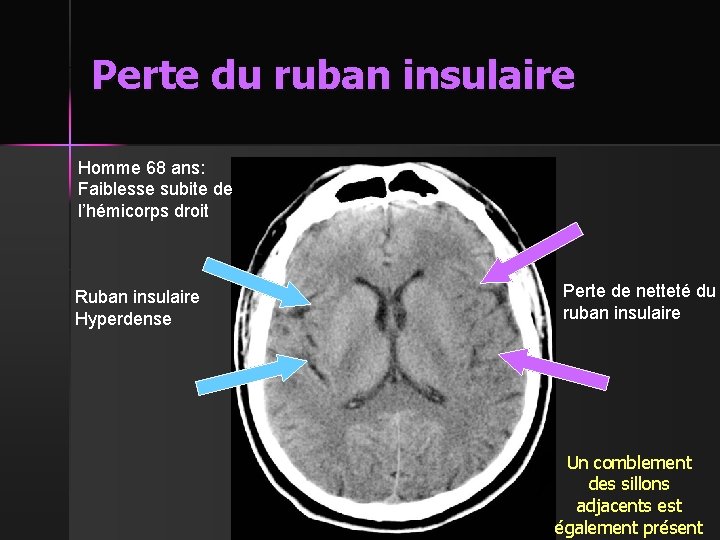 Perte du ruban insulaire Homme 68 ans: Faiblesse subite de l’hémicorps droit Ruban insulaire