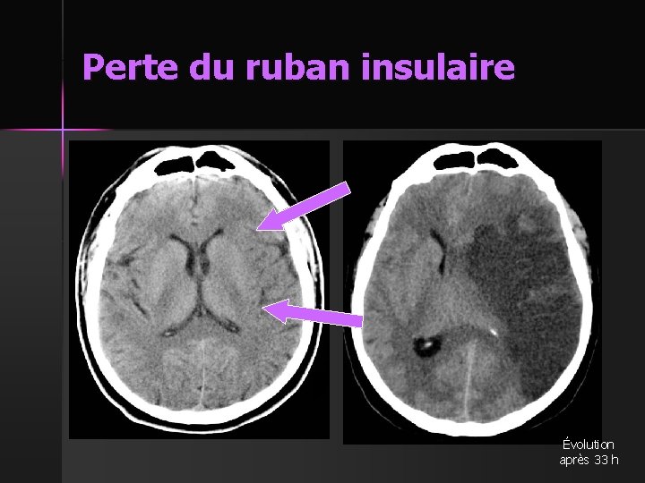 Perte du ruban insulaire Évolution après 33 h 