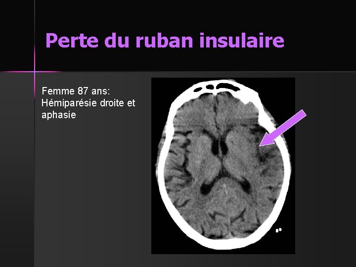 Perte du ruban insulaire Femme 87 ans: Hémiparésie droite et aphasie 