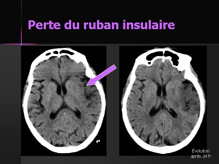 Perte du ruban insulaire Évolution après 24 h 