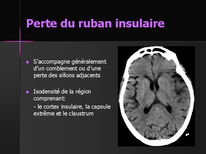 Perte du ruban insulaire n S’accompagne généralement d'un comblement ou d'une perte des sillons