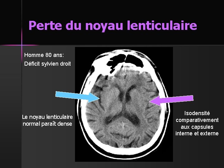 Perte du noyau lenticulaire Homme 80 ans: Déficit sylvien droit Le noyau lenticulaire normal