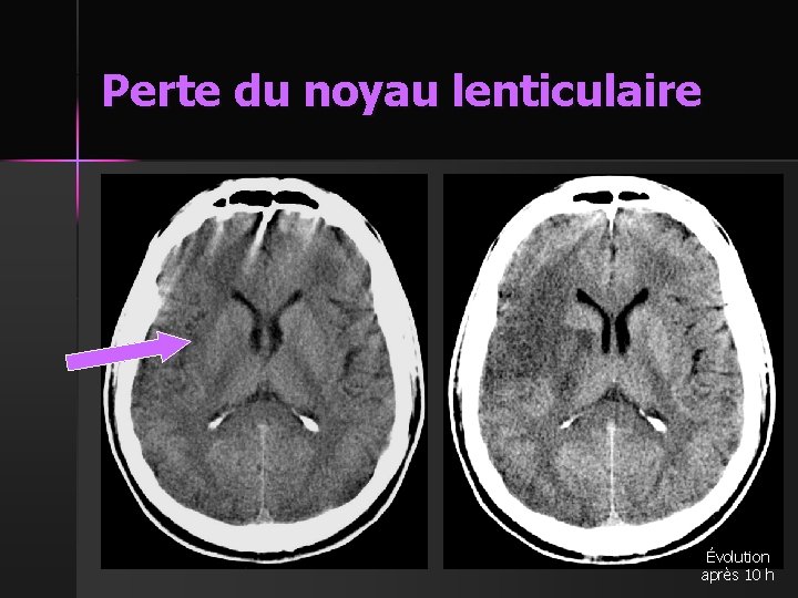 Perte du noyau lenticulaire Évolution après 10 h 