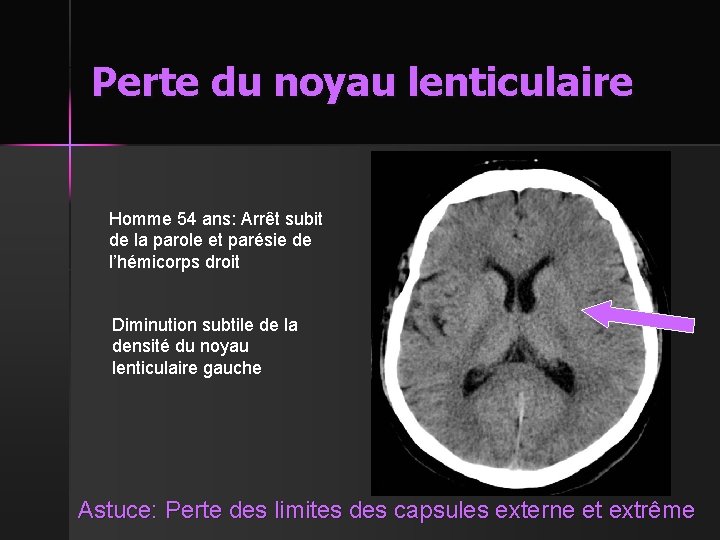 Perte du noyau lenticulaire Homme 54 ans: Arrêt subit de la parole et parésie