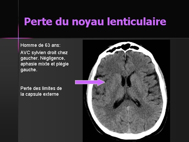 Perte du noyau lenticulaire Homme de 63 ans: AVC sylvien droit chez gaucher. Négligence,