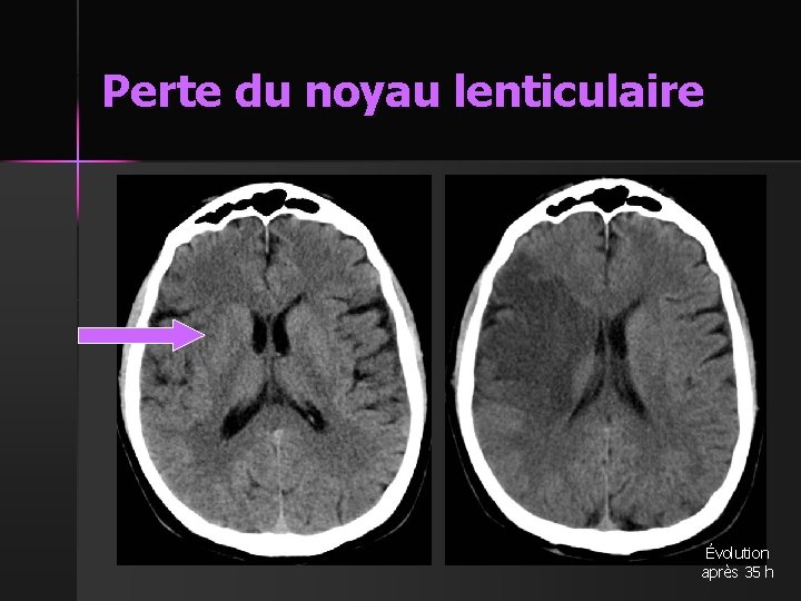 Perte du noyau lenticulaire Évolution après 35 h 