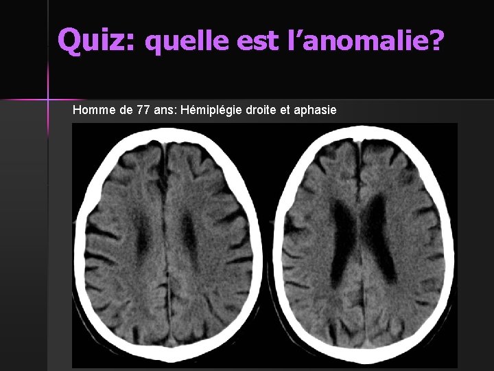 Quiz: quelle est l’anomalie? Homme de 77 ans: Hémiplégie droite et aphasie 