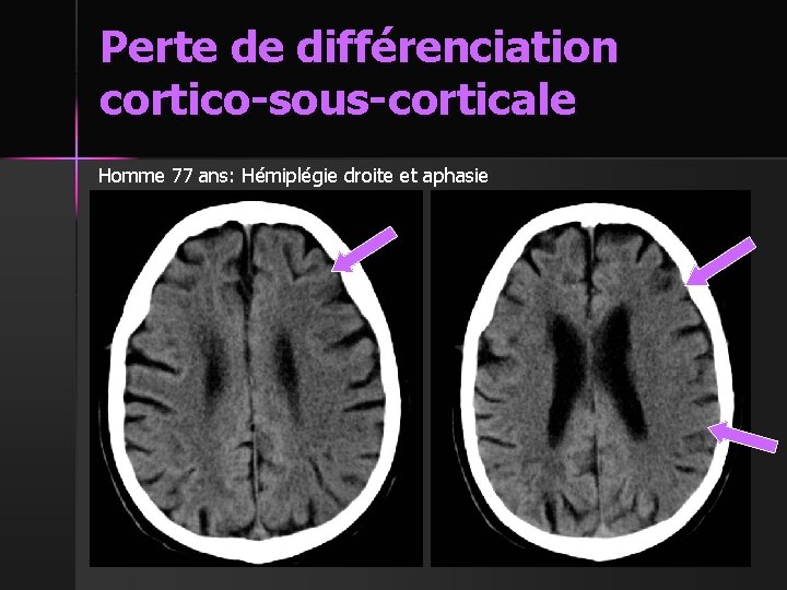 Perte de différenciation cortico-sous-corticale Homme 77 ans: Hémiplégie droite et aphasie 