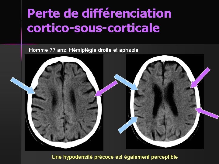 Perte de différenciation cortico-sous-corticale Homme 77 ans: Hémiplégie droite et aphasie N N N